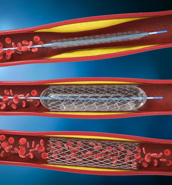 Atherosclerosis of Aorta