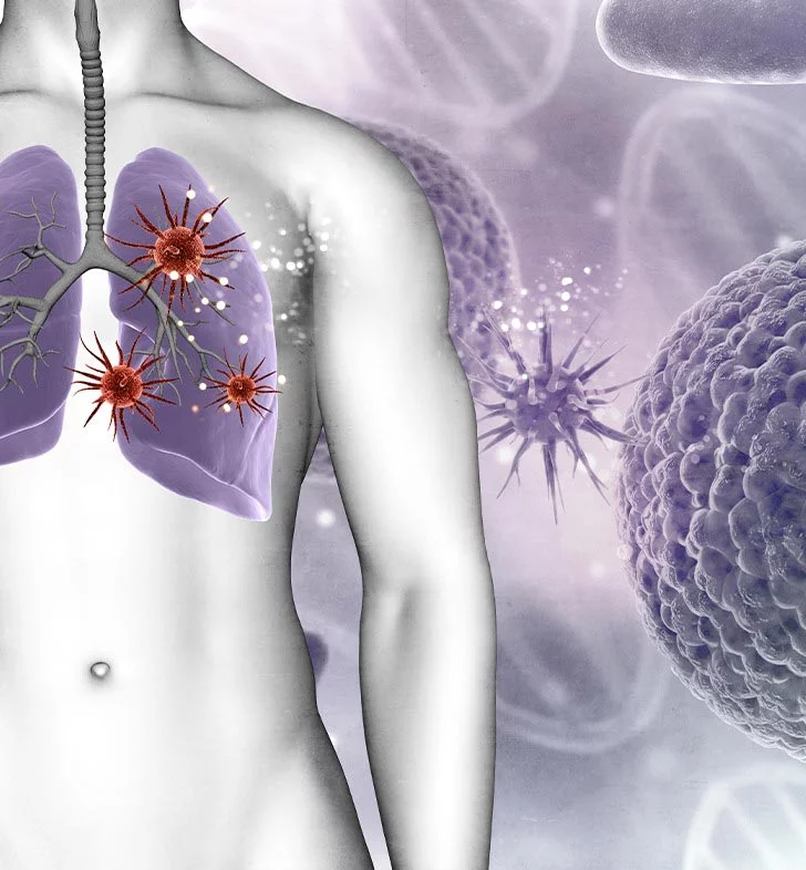 لمفومة الخلايا البائية 