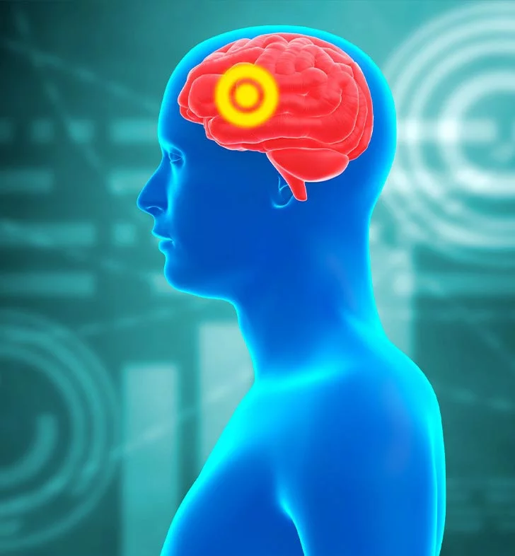 تمدد الأوعية الدموية الدماغية 